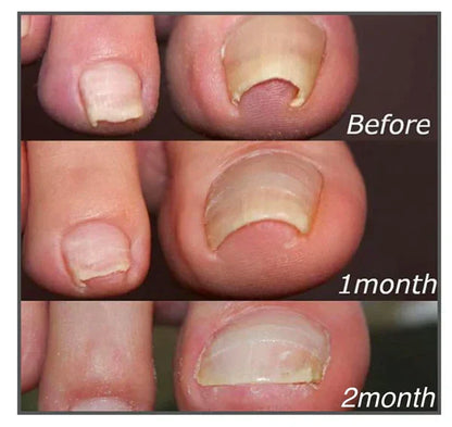 Correction Patches For Beautiful And Healthy Nails