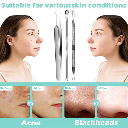Perofessional Facial Blackheads Remover